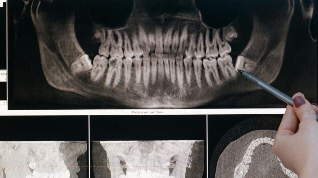 Szakszerű bölcsességfog eltávolítás a MyDent fogorvos Budapesten