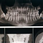 Szakszerű bölcsességfog eltávolítás a MyDent rendelőben