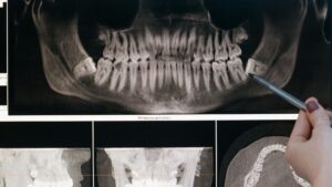 Szakszerű bölcsességfog eltávolítás a MyDent fogorvos Budapesten