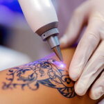 Tetoválás eltávolítás: hány alkalom szükséges? Így készülj fel!