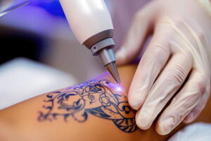 tetoválás eltávolítás
