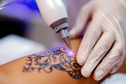 tetoválás eltávolítás